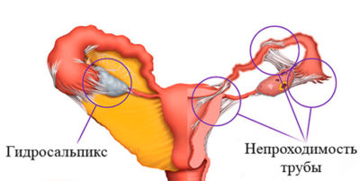 Проходимость маточных труб: виды диагностики